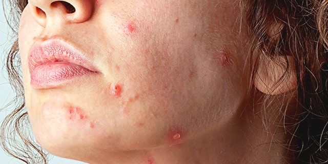 Пример актинического кератоза на лице